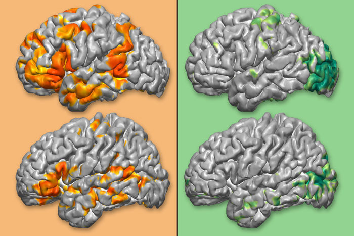 Medtronic, Washington University to expand 3-D brain mapping tool ...